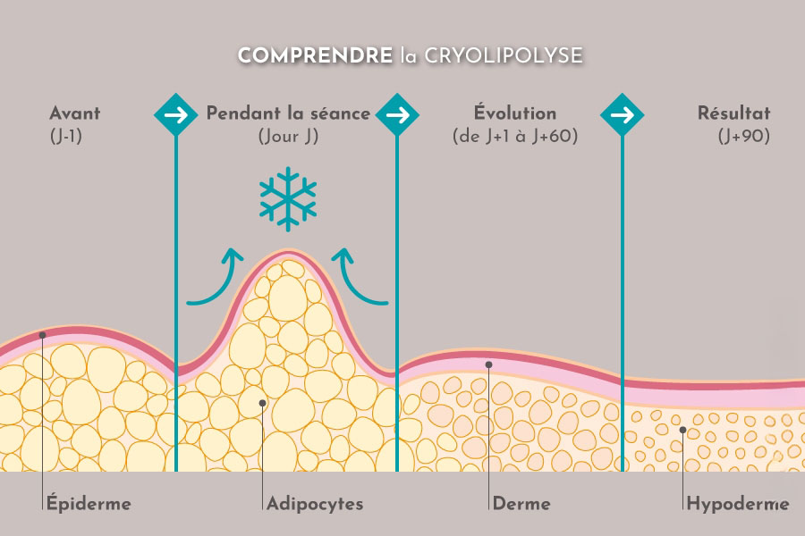 Comment fonctionne la cryolipolyse ?
